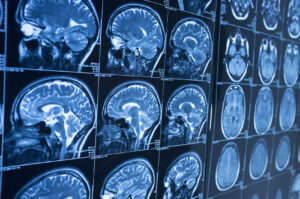 How Trial Lawyers of Wisconsin Can Help if You Suffer a Brain Injury in Milwaukee